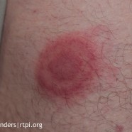 Lyme Disease bullseye rash